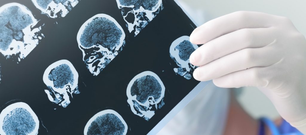 machine-learning-breakthrough-delivers-alzheimers-diagnosis-AI-2-1024×455